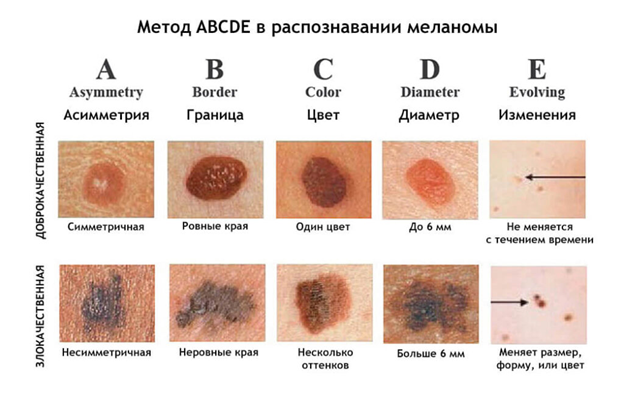 Рак кожи